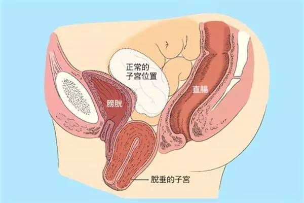 【產(chǎn)后修復(fù)】盆腔臟器脫垂，你有嗎？