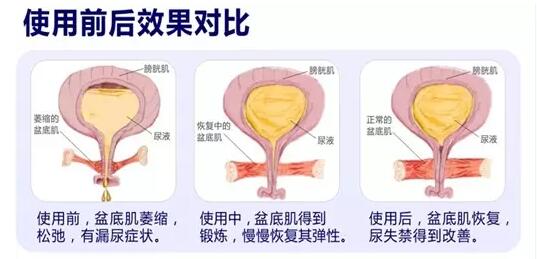 盆底康復(fù)治療怎么做？產(chǎn)后盆底功能檢測很重要