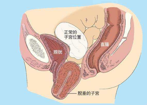 人們常說(shuō)，產(chǎn)后女性做好盆底肌修復(fù)是關(guān)鍵，但盆腔器官的脫垂你也得注意