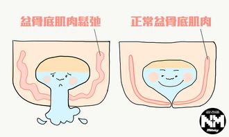 盆底肌損傷后沒(méi)有癥狀可以不治療嗎