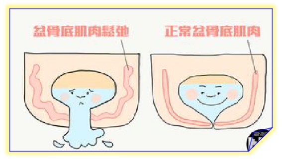 盆底康復(fù)治療怎么做，盆底肌修復(fù)常見的十大問題（中）