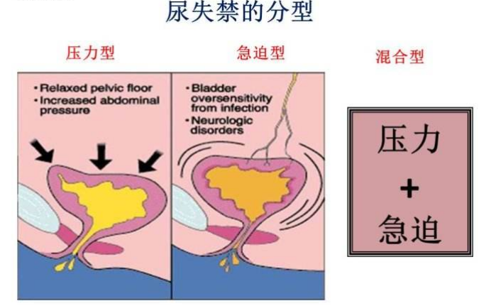 產后盆底肌怎么修復|尿失禁的類型，傻傻分不清