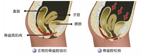 盆底功能檢測很重要，盆底肌松弛了會有什么表現(xiàn)呢？