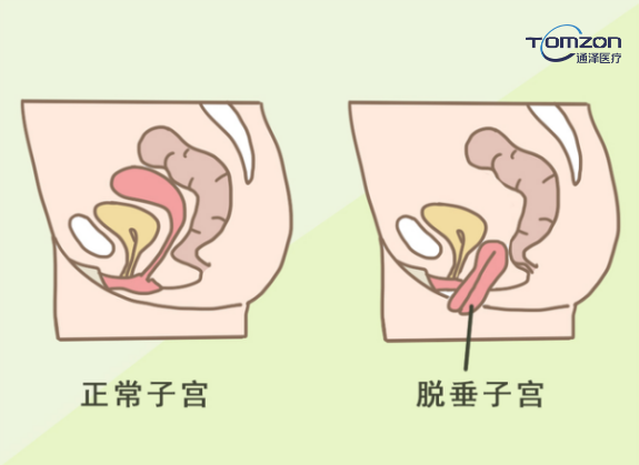 你害怕子宮脫垂嗎？盆底肌修復(fù)儀器來拯救你