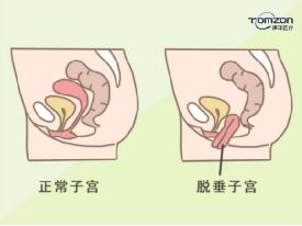 盆底肌修復(fù)儀器用對(duì)地方治療很有效