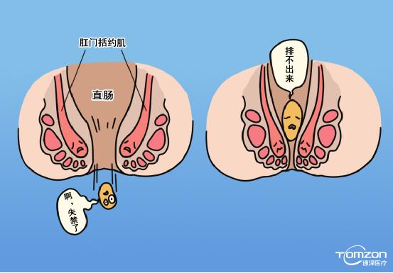 便秘跟盆底肌有什么關(guān)系，能用盆底肌修復(fù)儀器治療嗎？