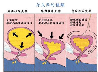 產后盆底肌修復